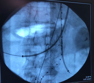 Técnica ch-EVAR intraoperatoria. Posicionamiento de los cables guía en la aorta y arterias renales derecha e izquierda. Prótesis listas para ser liberadas.