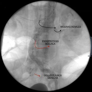 Angiografía de aorta abdominal. Control angiográfico del resultado final del procedimiento, demostrando exclusión del aneurisma en toda su extensión y ausencia de fugas.