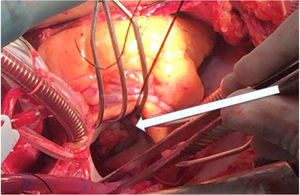 Imagen quirúrgica, atriotomía izquierda donde se puede apreciar la masa en el velo anterior de la válvula mitral (flecha).