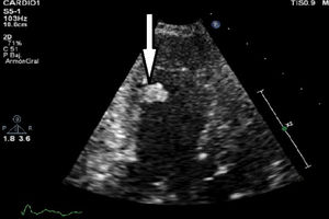 ETT, eje 2 cámaras. Visualización de fibroelastoma papilar en septo del ventrículo izquierdo.