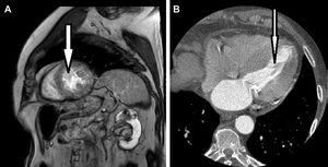 A) RMC, corte sagital. Se observa masa a nivel de septo del ventrículo izquierdo que no capta contraste. B) TAC cardíaco. Corte axial. Se observa imagen compatible con masa a nivel de septo de ventrículo izquierdo.