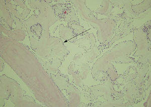 Fibroelastoma papilar, tinción de hematoxilina-eosina: Proyecciones papilares formadas por tejido conjuntivo escasamente celular, tapizado por una sola fila de células endoteliales.