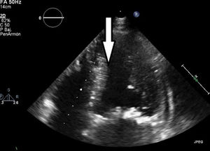 ETT postoperatorio, eje 4 cámaras con visualización de ventrículo izquierdo con ausencia de fibroelastoma papilar tras resección quirúrgica.
