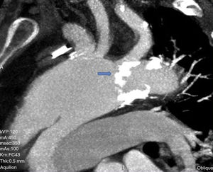 Flap de disección en aorta ascendente. Ateromatosis a nivel de nacimiento de arteria subclavia (flecha azul).