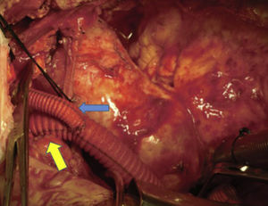 «Y-graft». Arteria carótida izquierda (flecha azul); tronco braquiocefálico (flecha amarilla). Lazo de seda negro en vena innominada.