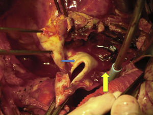 Pinzamiento de aorta ascendente y apertura de la misma. Se observa la membrana de disección (flecha azul), con hematoma intramural (flecha amarilla).