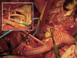 Apertura de aorta descendente. Se observa Foley oclusora (amarilla) y catéter Fogarty ocluyendo subclavia izquierda (celeste). En cuadro arriba a la izquierda se observa disección en aorta descendente.