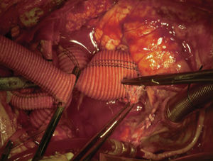 Anastomosis proximal de aorta con prótesis. Anastomosis distal ya realizada. Pinzamiento en base de prótesis de 14mm, aún no implantada.
