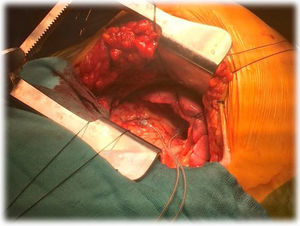 Implante epicárdico mediante minitoracotomía izquierda.