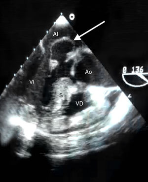 Plano de 3 cámaras en ecocardiograma transesofágico mostrando el aneurisma mitral (flecha). AI: aurícula izquierda; Ao: aorta; S: septo; VD: ventrículo derecho; VI: ventrículo izquierdo.