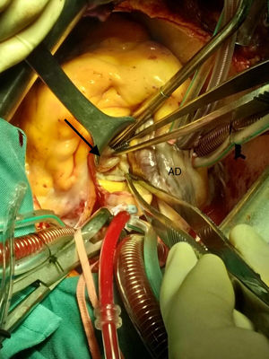 Imagen intraoperatoria. A través de la aortotomía se accede a la válvula mitral. El saco aneurismático (flecha) se muestra en las pinzas de la parte superior de la imagen. AD: aurícula derecha.