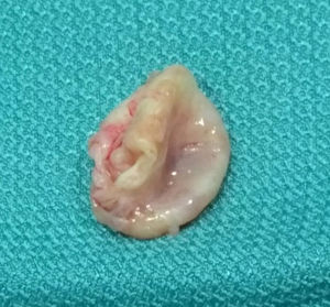 Pieza quirúrgica de tejido valvular con forma sacular, de aproximadamente 15-20mm de tamaño, que corresponde al aneurisma del velo anterior de la válvula mitral extirpado desde su base.
