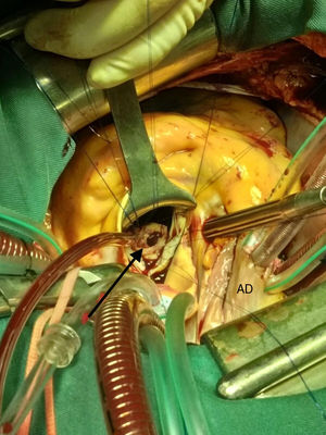 Imagen intraoperatoria. A través de la aortotomía se observa el defecto en el velo anterior que deja la resección del aneurisma (flecha). Puntos en «U» alrededor del defecto. AD: aurícula derecha.