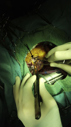 Imagen intraoperatoria. Resultado de la reparación mitral con parche de pericardio autólogo que cierra el defecto en su totalidad (flecha). Puntos en «U» en el anillo valvular aórtico para posterior implante de bioprótesis. AD: aurícula derecha.
