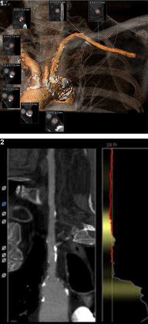 Reconstrucción de la angioTAC para estudio del acceso subclavio con el programa 3mensio® Vascular.