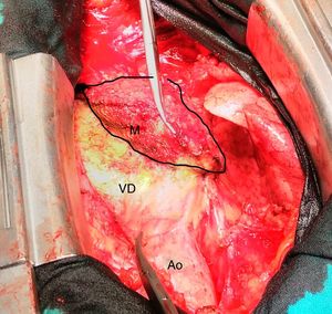 Masa (delimitada por línea negra) fuertemente adherida al ventrículo derecho en el proceso de exéresis (Ao: aorta; M: masa; VD: ventrículo derecho).