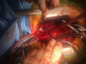 Imagen del campo quirúrgico correspondiente al primer período de parada circulatoria. Se observa la arteriotomía del tronco pulmonar principal y se puede apreciar la masa de aspecto fibroso ocupando el lecho de la arteria pulmonar.