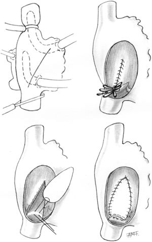Esquemas de la canulación auricular y de las distintas fases de la operación.