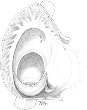 Anatomía de una comunicación interauricular tipo defecto de fosa oval con limbo incompleto en situación baja y con válvula de Eustaquio grande.