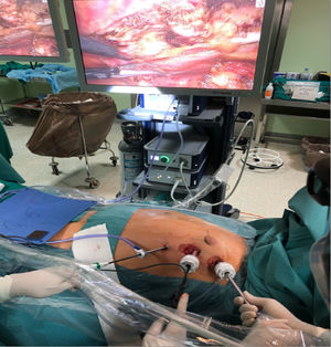 Visión de campo quirúrgica en 3D mediante cámara endoscópica. Colocación de trócares y disección endoscópica de la arteria mamaria.