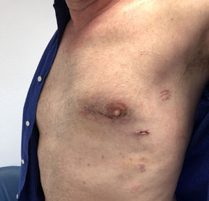 Heridas quirúrgicas a los 10 días de la cirugía.