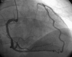 Oclusión de tercio proximal de arteria descendente anterior visualizada a través de coronaria derecha.
