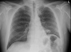 Radiografía postoperatoria. Leve elevación hemidiafragma izquierdo.