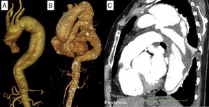 TC preoperatorio. A) Aneurisma de aorta ascendente distal, cayado aórtico y descendente. B) Aneurisma de aorta ascendente y descendente. C) Disección crónica.