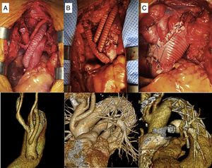 Imágenes quirúrgicas de las técnicas de implante de los TSA. A) Pastilla y bypass a subclavia izquierda. B) Injerto trifurcado. C) Pastilla única.