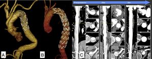 TC postoperatorio. A) Prótesis híbrida E-vita Open Plus. B) Prótesis híbrida E-vita y extensión con TEVAR. C) Evolución de la falsa luz en una disección aórtica aguda tipo A tratada con prótesis híbrida E-vita.