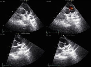 Transthoracic echocardiography images that show a vibratile bilobulated 15mm mass in main pulmonary artery depending on the pulmonary valve with no signs of valve dysfunction.
