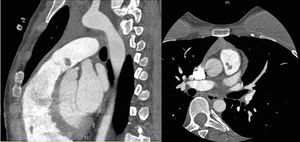 Computed tomography images showing the mass hovering in the main pulmonary artery and its peduncle extending to the posterior leaflet of the pulmonary valve.
