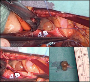 Intraoperative images showing the transverse incision in main pulmonary artery and the 10mm bilobulated mass with a clear short pedicle attached to the posterior leaflet of pulmonary valve.