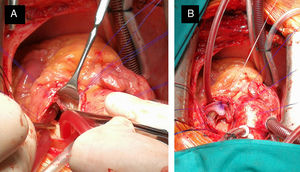 En primer lugar, se procedió a la sustitución de la válvula pulmonar sin clampaje aórtico. A) Fotografía del campo quirúrgico, realizada la arteriotomía pulmonar longitudinal ampliada al tracto de salida del ventrículo derecho, con referenciado de los bordes de la arteriotomía. Se aprecia la válvula pulmonar con velos engrosados y retraídos. B) Fotografía realizada durante el implante de la bioprótesis pulmonar. Se ha anclado la prótesis a la parte inferior del tracto de salida del ventrículo derecho, siendo el siguiente paso la ampliación del techo con parche de pericardio heterólogo, con anclaje de la parte superior de la prótesis al mismo para posicionarla axial al conducto de la arteria pulmonar.