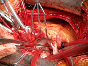 Fotografía del campo quirúrgico con visión de la válvula mitral. Acceso a la misma a través del septo interauricular, ya en isquemia cardiaca. Se observa una importante fusión comisural y engrosamiento de los velos, intuyendo también el engrosamiento del aparato subvalvular que provoca la retracción de los velos mitrales.