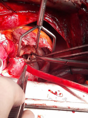 Fotografía del campo quirúrgico con visión de la válvula tricúspide. Acceso a la misma por atriotomía derecha. Se aprecian los velos de la válvula tricúspide totalmente rígidos y retraídos, requiriendo tirar firmemente de los mismos para su resección.