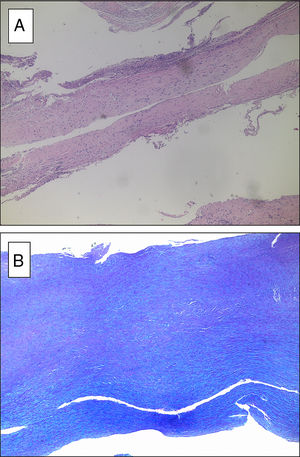 Análisis microscópico de las muestras valvulares quirúrgicas. A) Tinción con hematoxilina-eosina. Se observa predominio de color rosa correspondiente a la matriz extracelular de predominio mixoide. B) Tinción con azul-PAS alcián. Se aprecia el predominio de color azul que tiñe la matriz extracelular de mucopolisacáridos.