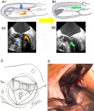 A1 y A2) imagen esquemática y ecocardiográfica, respectivamente, del mecanismo de obstrucción del tracto de salida y de la insuficiencia mitral; B1 y B2) imagen esquemática y ecocardiográfica, respectivamente, del efecto de la miectomía en el alivio de la obstrucción del tracto de salida e insuficiencia mitral; C) dibujo esquemático de la plicatura longitudinal del velo anterior mitral; D) imagen del campo quirúrgico de la miectomía.