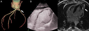 A) Reconstrucción tridimensional de ACTC mostrando el muñón de la arteria marginal ocluida (flecha). B) Ecocardiograma con contraste mostrando el seudoaneurisma. C) Resonancia magnética cardíaca con gadolinio, con realce tardío transmural en la pared lateral, con rotura de la misma (flecha).