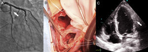 A) Coronariografía invasiva mostrando la oclusión completa ostial de la primera rama marginal (flecha). B) Imagen intraoperatoria mostrando el seudoaneurisma en la cara lateral abierto, con trombo adherido. C) Ecocardiograma postoperatorio donde se puede apreciar el parche en la cara lateral (flecha).
