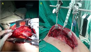 Sujeción del dispositivo a 2 tipos de separadores esternales. A: separador clásico de Favaloro modificado para disección mamaria. B: separador confeccionado por nuestro equipo. Este fue uno de los pacientes con apertura accidental de la pleura (distal).