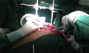 Disección de mamaria derecha. Detalle de la maniobra para separar, mediante lazo de seda, el segmento proximal de la vena mamaria del recorrido de la arteria. En la figura 2 B (mamaria izquierda) ya ha sido anclado el punto al borde de la herida y se observa la vena separada.