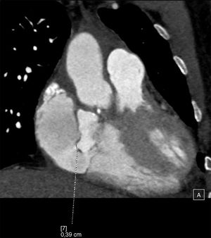 Pseudoaneurisma en tracto de salida de ventrículo izquierdo fistulizado a aurícula derecha. Medida del tamaño de la fístula.