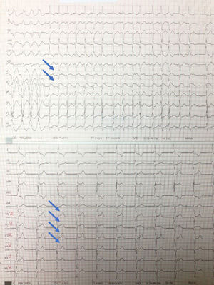 ECG de 12 derivaciones con precordiales derechas.