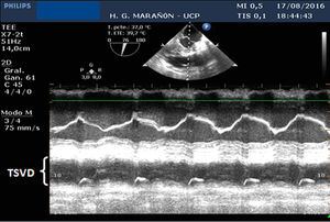 Plano medio-esofágico modificado de entrada-salida del VD. Mediante modo M se aprecia disminución de la contractilidad del TSVD.