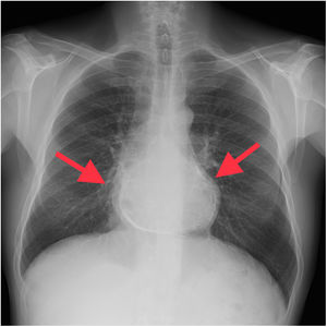 Radiografía de tórax anteroposterior de un paciente con pericarditis constrictiva donde podemos observar (flechas rojas) las abundantes calcificaciones pericárdicas.