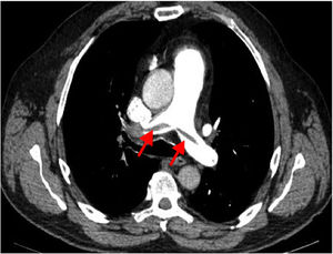 AngioTC de tórax. Se observa trombo en la bifurcación de ambas arterias pulmonares (flechas).