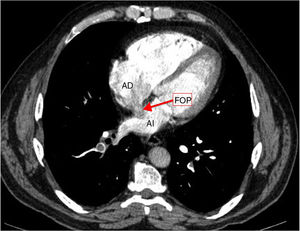 AngioTC de tórax. Se visualiza foramen oval permeable comunicando ambas aurículas. AD: aurícula derecha; AI: aurícula izquierda; FOP: foramen oval permeable.