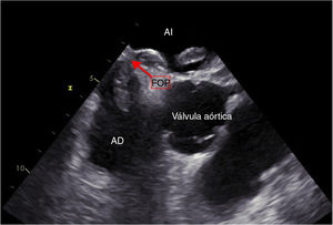 Ecocardiografía transesofágica. Se observa trombo en tránsito a través de FOP. AD: aurícula derecha; AI: aurícula izquierda; FOP: foramen oval permeable.