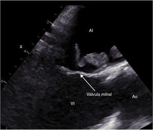 Ecocardiografía transesofágica. Se visualiza trombo en aurícula izquierda cercano a válvula mitral. AI: aurícula izquierda; Ao: arteria aorta; VI: ventrículo izquierdo.
